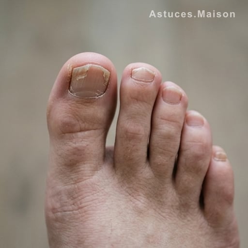 Ongles des pieds fissurés : le signe d’une carence
